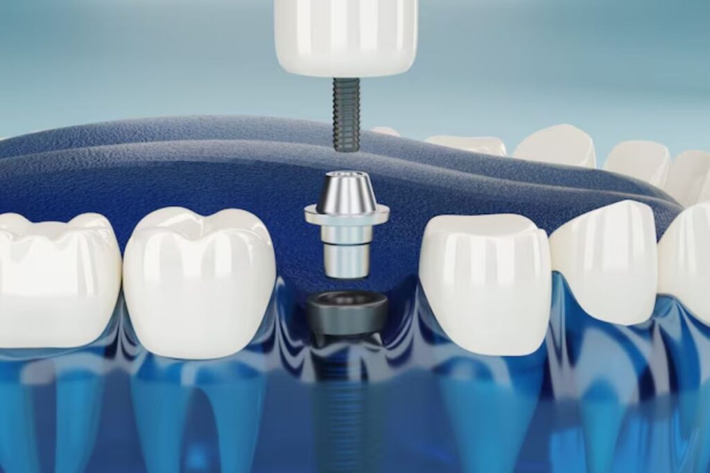 Dental Implants in Hoover