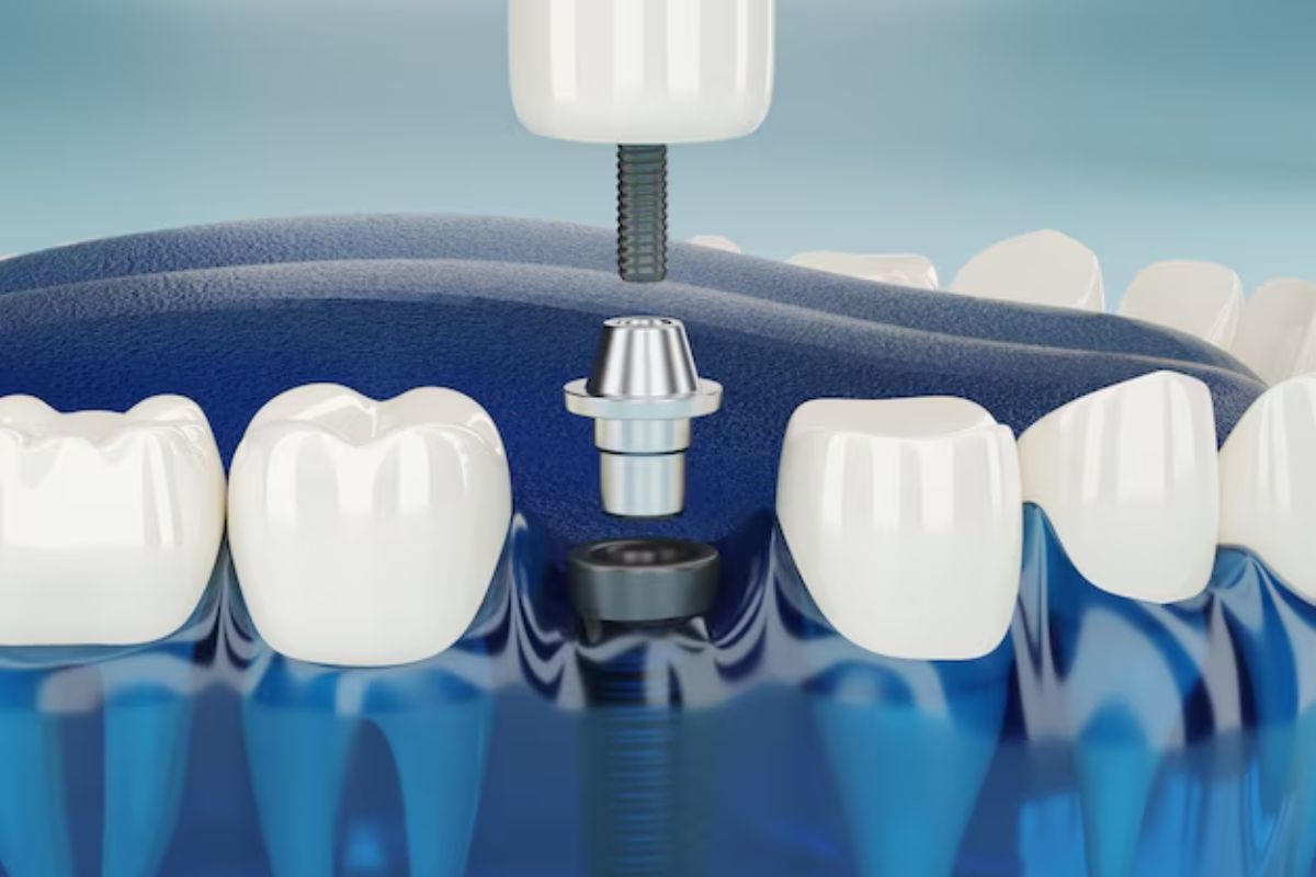 Why Dental Implants in Hoover Are the Gold Standard for Tooth Replacement