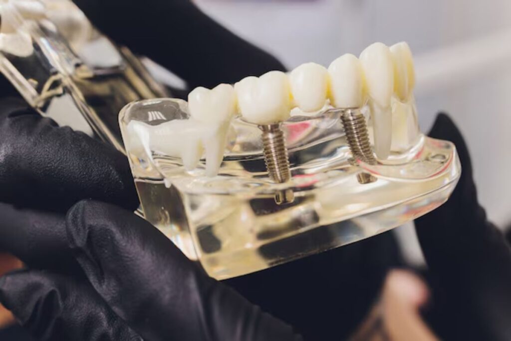Dental Implants in Hoover
